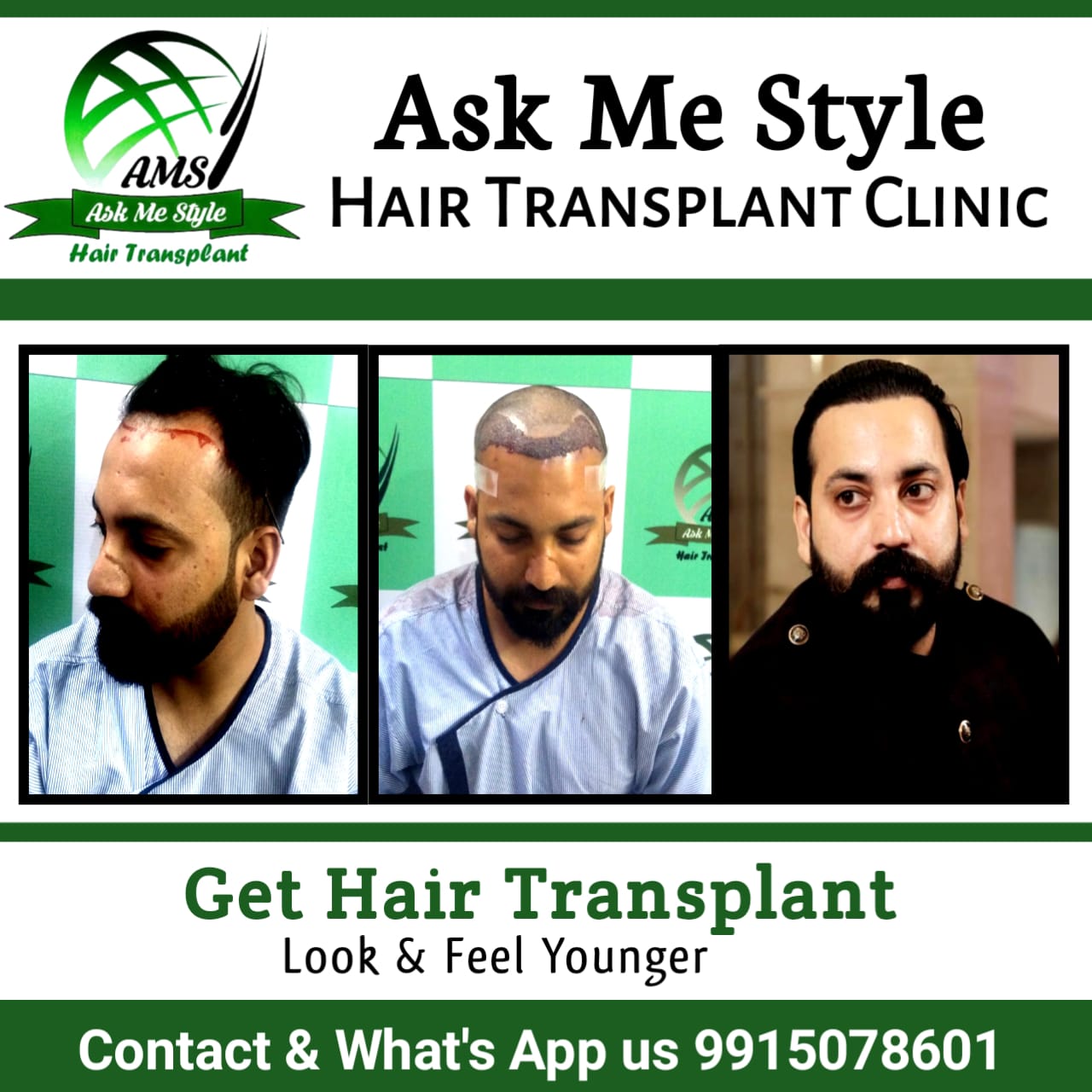 Bye to Baldness - Best Hair Transplant in Ludhiana,Punjab - - Home ...