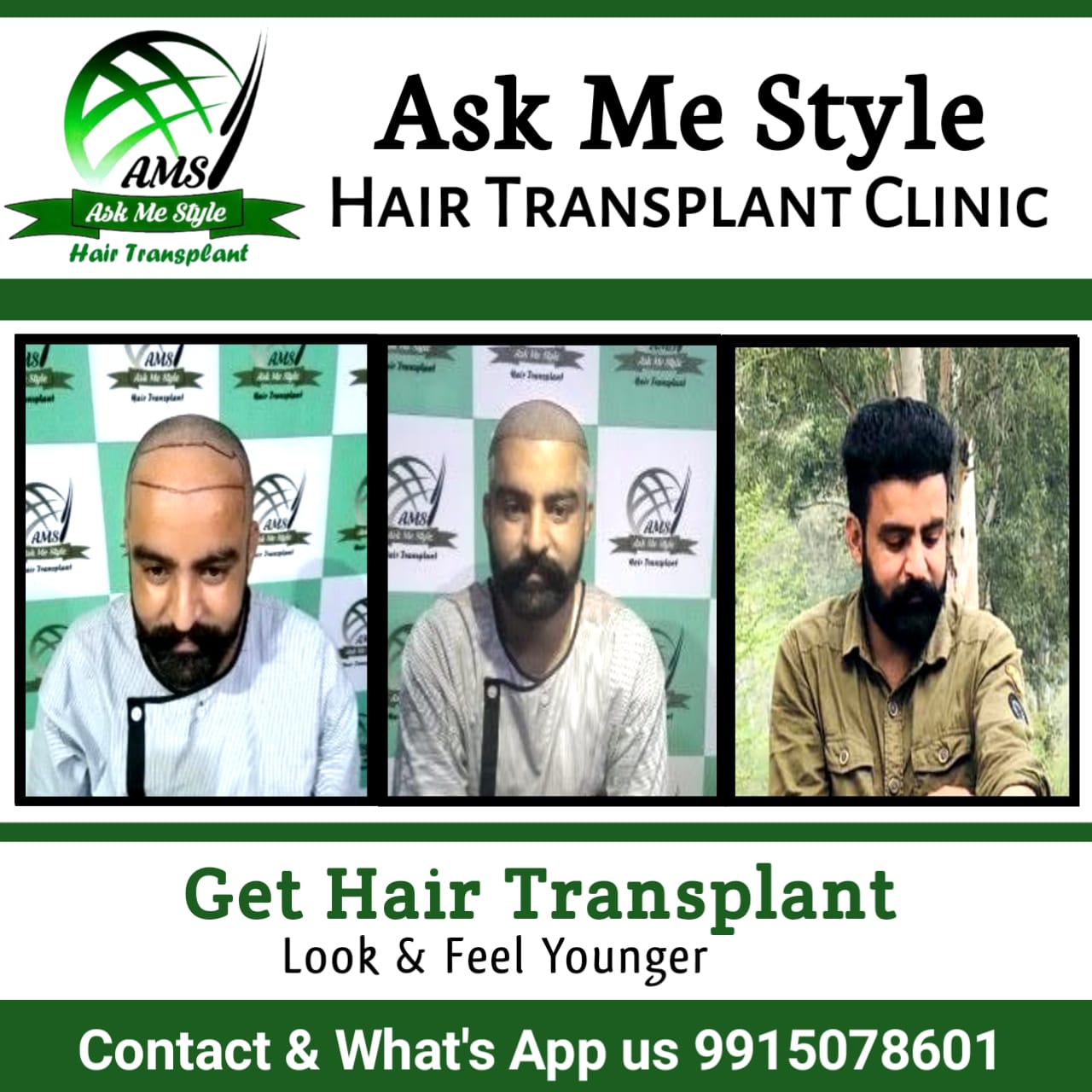 Hair Transplant in Ludhiana Punjab  Affordable Hair Restoration  NHT